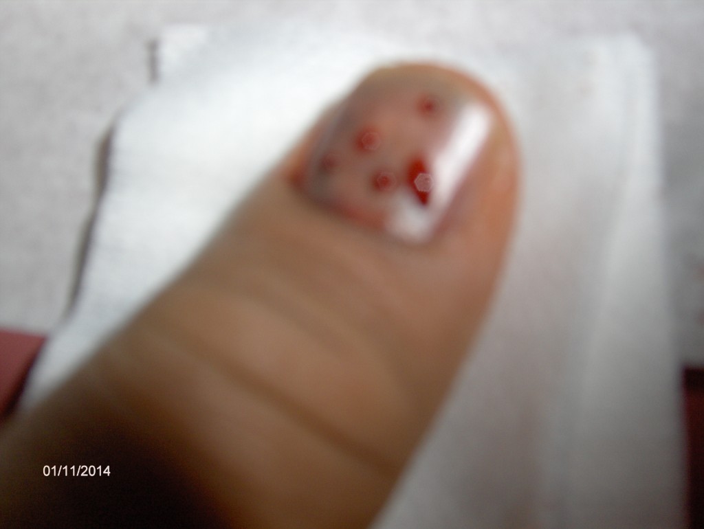 Cuts Under Nail