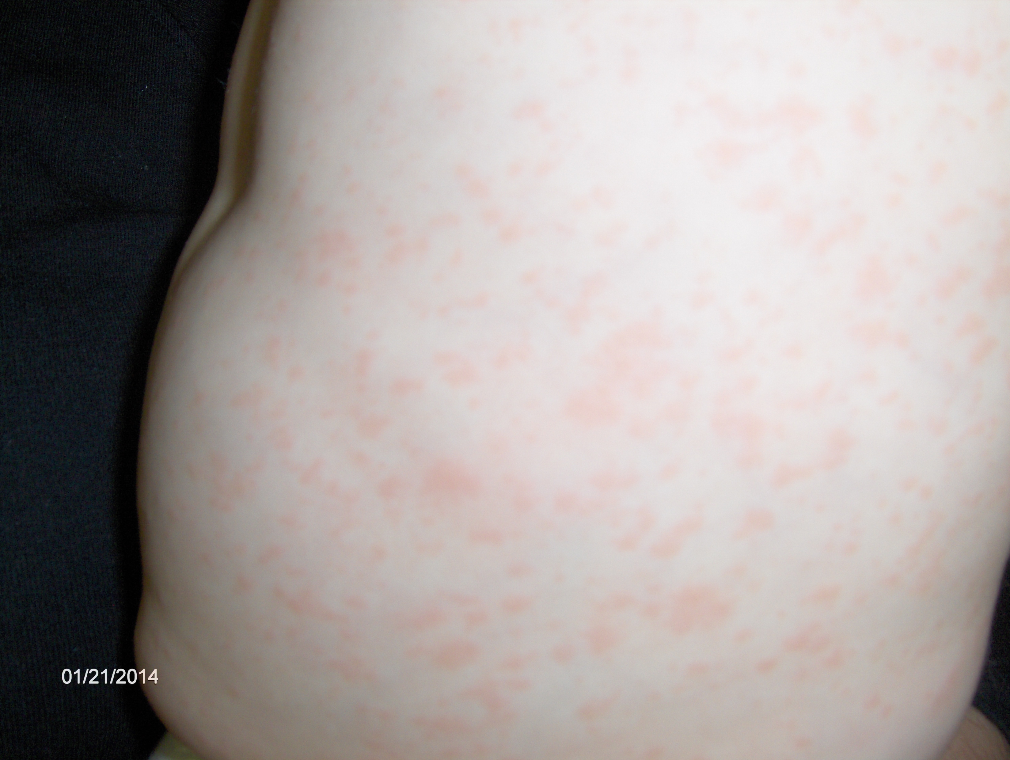 Low grade fever followed by rash, Viral gastroenteritis (stomach flu)