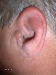 swimmer's ear, pain in the ear, swelling of the ear, redness of the ear