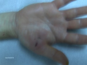 splinter of hand surgically removed 