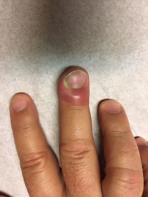 Infection of the nail of the Finger