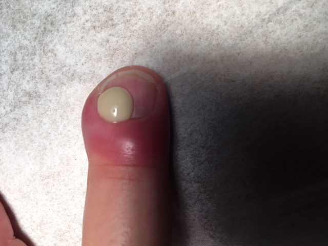 Pus from the Nail