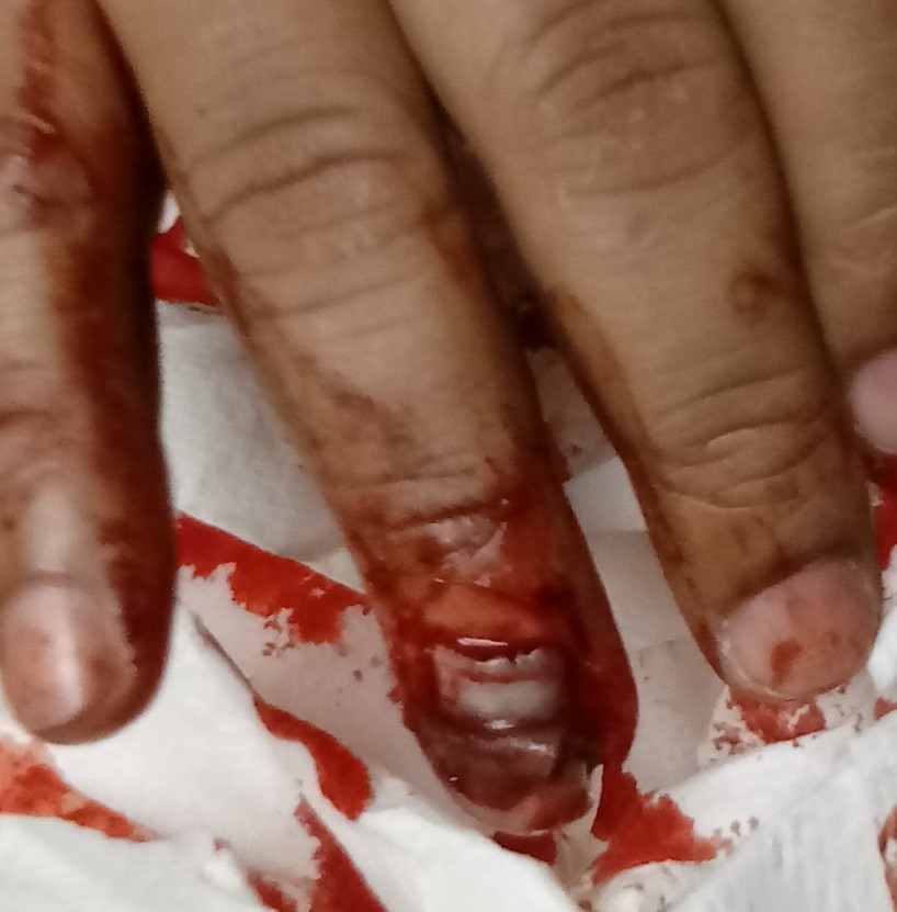 crush injury of the Finger