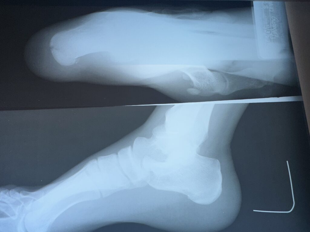 Fracture of heel
